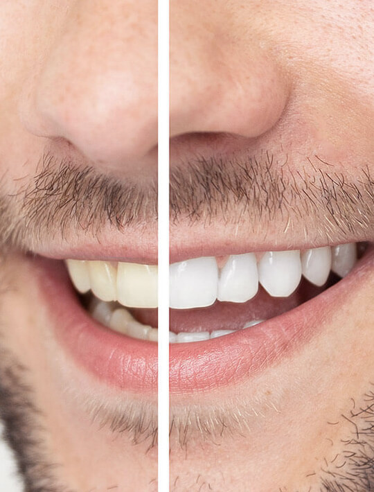 Types-of-Teeth-Whitening St Helena