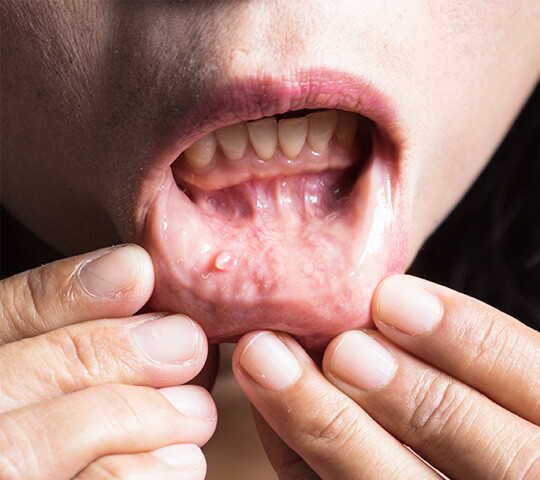 Gum-disease-in-St Helena