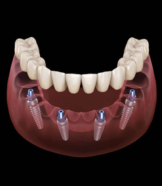 all-on-4-implant