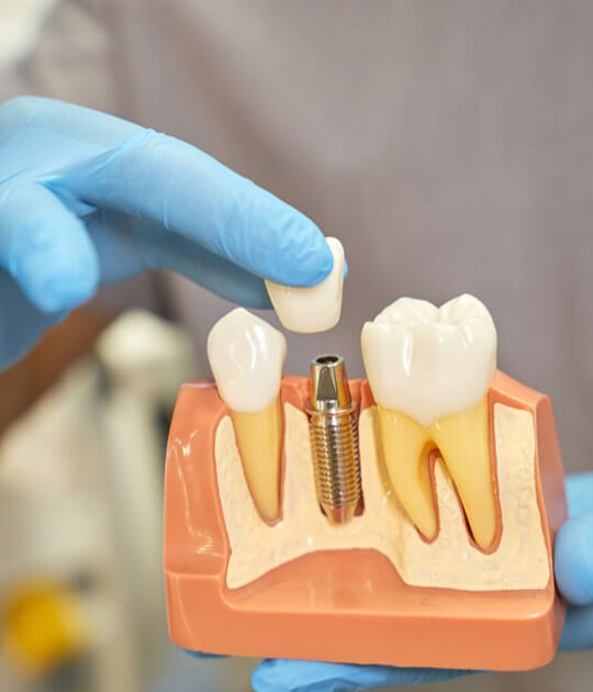implant-Installation-Process-St Helena