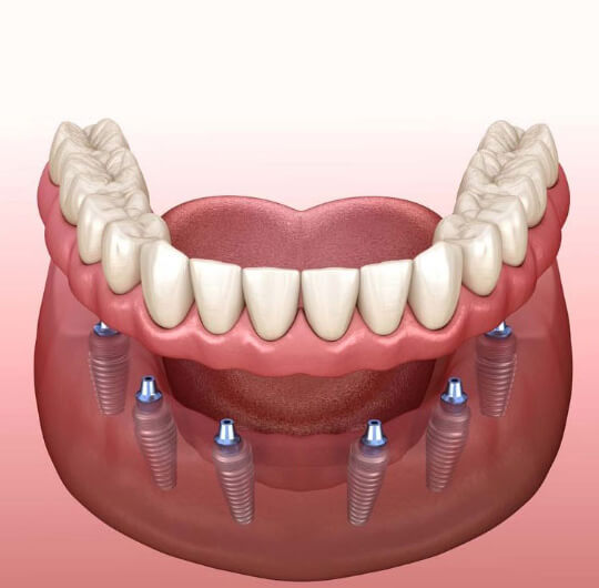 implant-supported-denture-St Helena