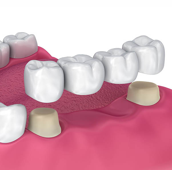 Dental Bridges St Helena