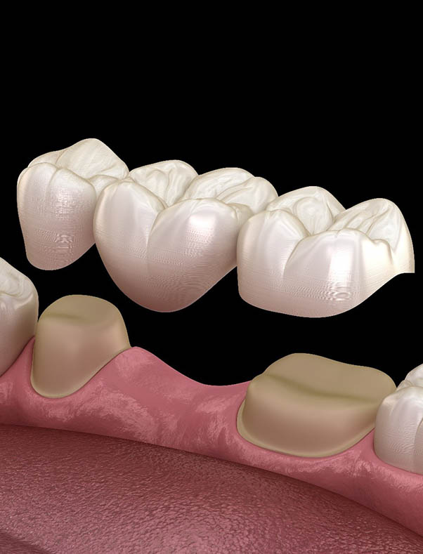 Dental Crowns St Helena