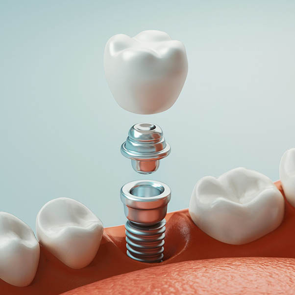 Dental Implant Restoration St Helena