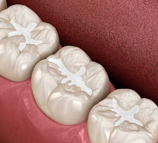 Dental Sealants in St Helena