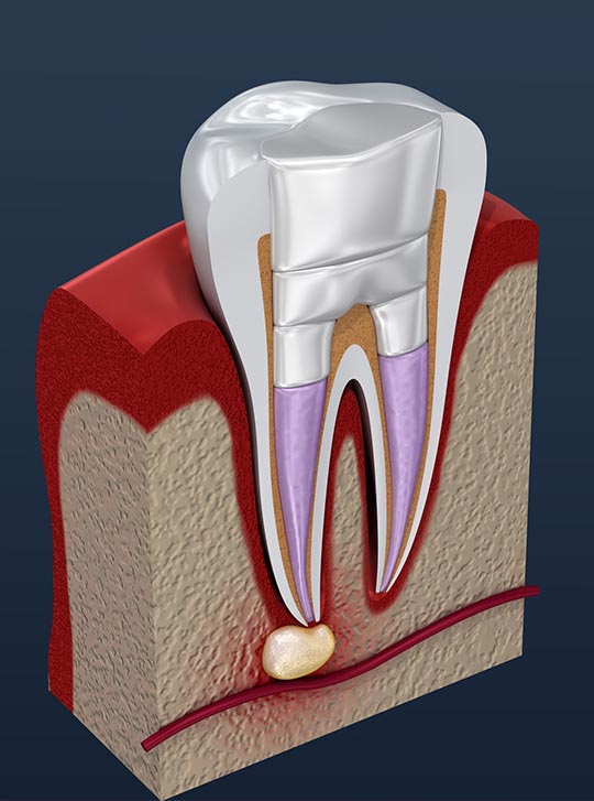 Root Canal Treatment St Helena