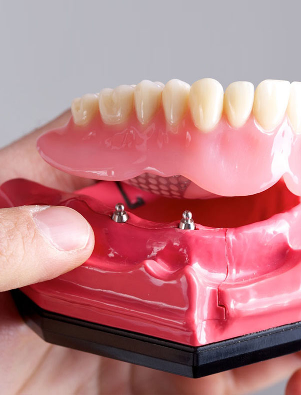 Dental Implants And Mini Dental Implants St Helena