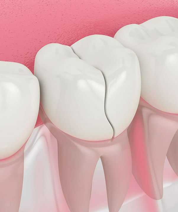 Dental Root Fractures St Helena