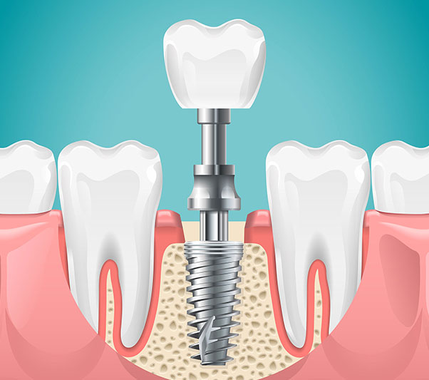 Bone Graft St Helena
