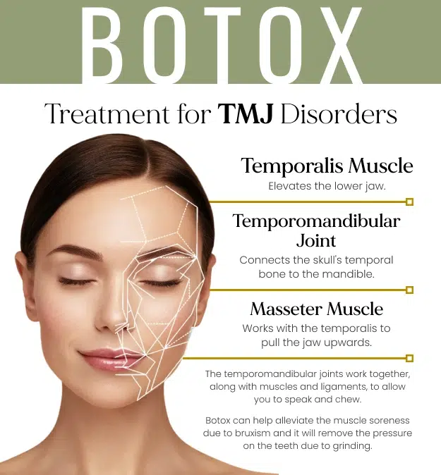 Diagram showing Botox injection sites for TMJ disorder treatment on female face anatomy.