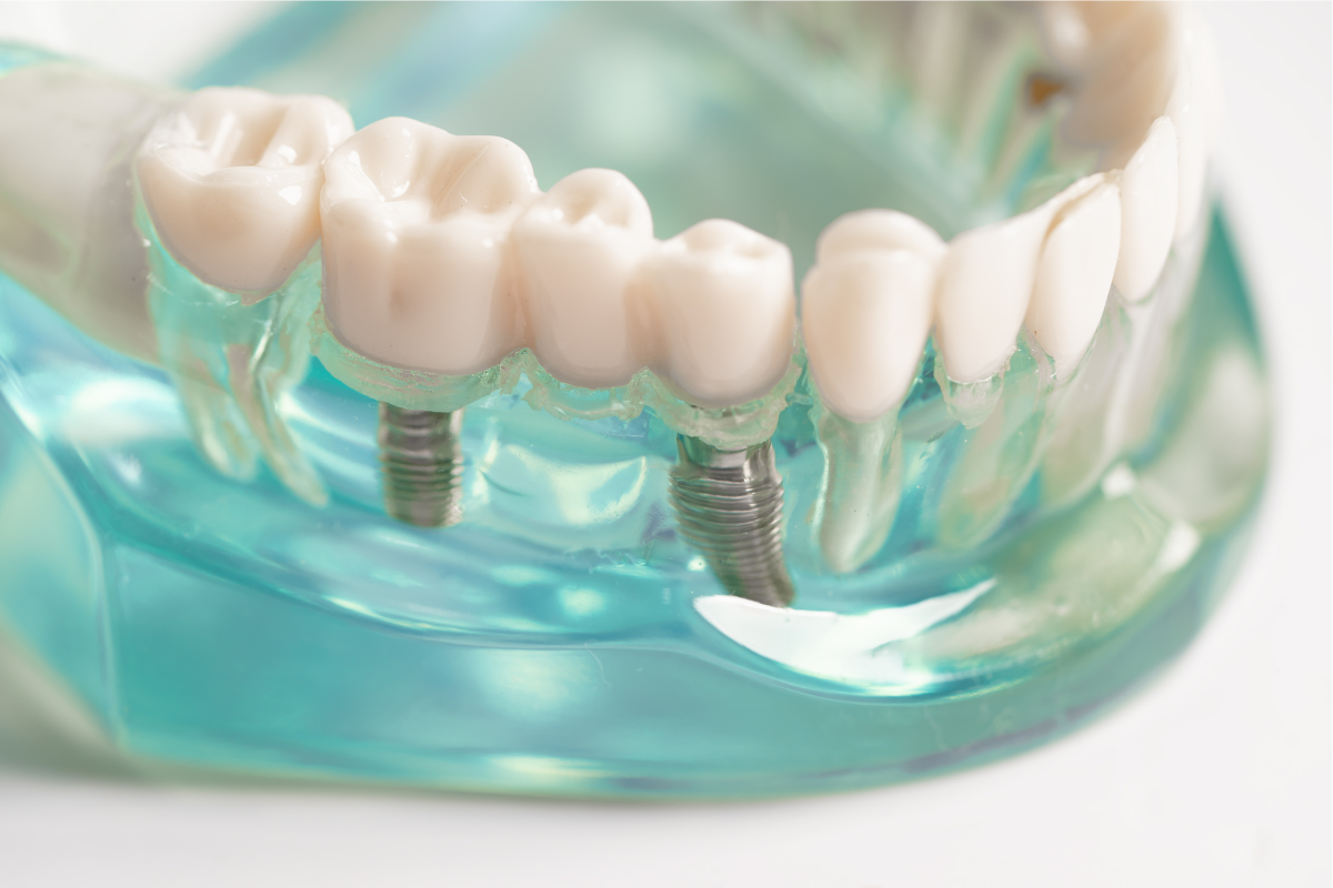 Dental Crowns St Helena